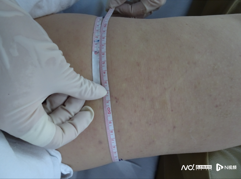 副本女子癌症术后腿肿如“象腿”，显微手术巧消肿294.png