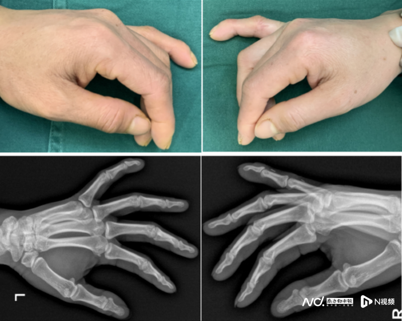 副本媒体-女子双手小指末端天生“驼背”，精巧V截骨手术矫正405.png